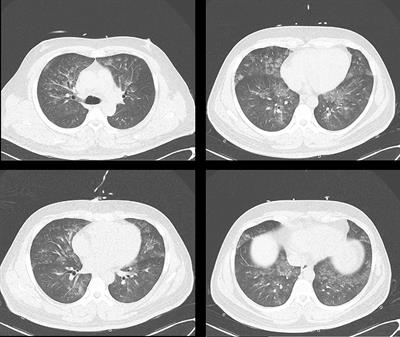 Case Report: An Unusual First Manifestation of a Pheochromocytoma